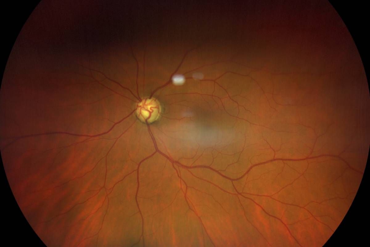 El glaucoma, una de las patolog�as oftalmológicas más frecuentes entre la población. Foto: DM. 